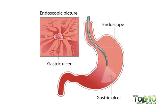 Gastric Perforation : 胃穿孔