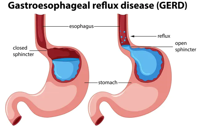 gastroesophageal sphincter : 胃食管括约肌