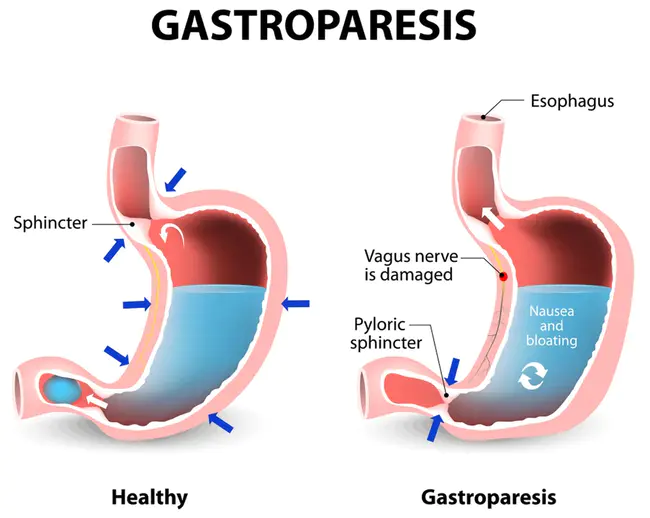 gastroparesis : 胃轻瘫