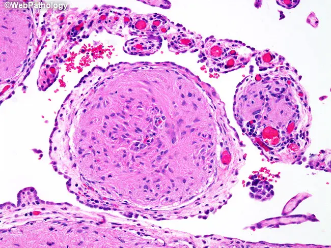 Gliomatosis Peritonei : 腹膜胶质瘤病