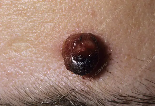 Granuloma Pyogenicum : 化脓性肉芽肿