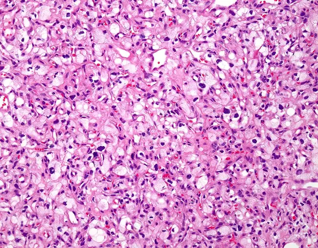 haemangioblastoma : 血肿母细胞瘤