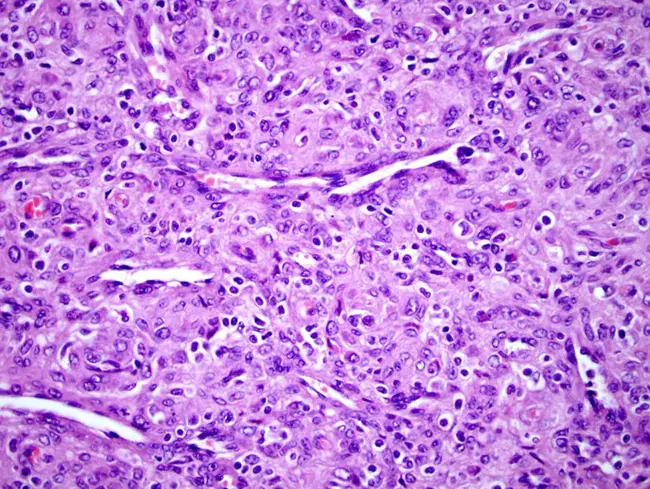 HaemangioPericytomA : 血肿性细胞瘤