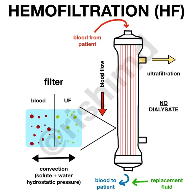 haemofiltration : 血液过滤