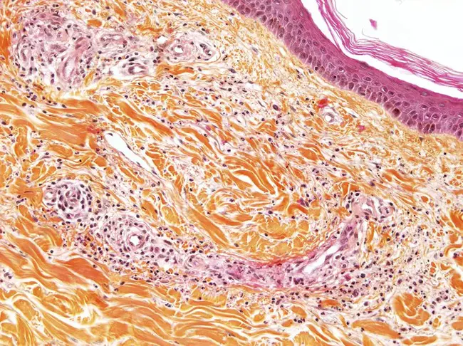 Hypersensitivity Vasculitis : 过敏性血管炎