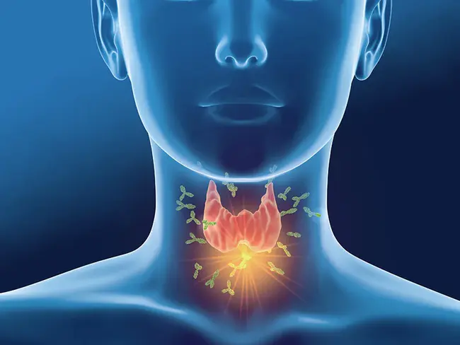 Hashimoto thyroiditis : 桥本甲状腺炎