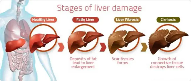 Hepatic Encephalopathy : 肝性脑病