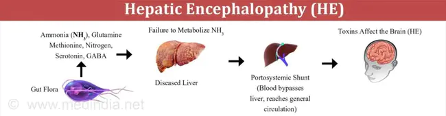 Hepatic Tumour : 肝肿瘤