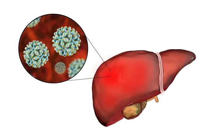 Hepatitis-Associated Antibody : 肝炎相关抗体