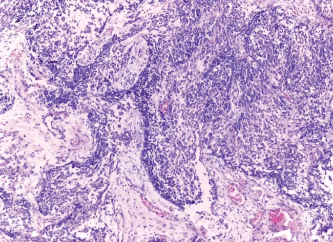 Hürthle cell adenoma : 红细胞腺瘤