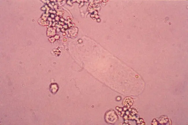 Hyaline Cast : 透明铸型