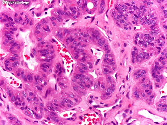 Hyalinising Trabecular Adenoma : 透明小梁腺瘤