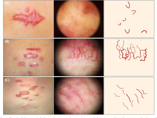 Hypertrophic Pyloric Stenosis : 肥厚性幽门狭窄