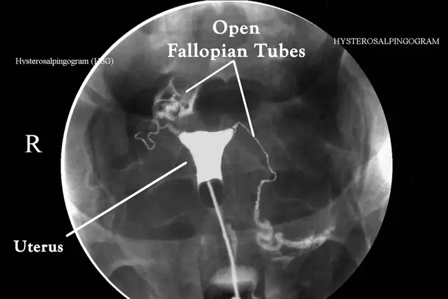 hysterosalpingogram : 子宫输卵管造影