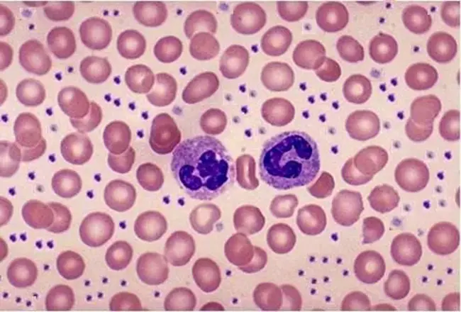 Immature Granulocyte : 未成熟粒细胞
