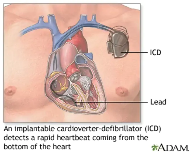 Implantable Cardioverter-Defibrillator : 植入式心脏复律除颤器