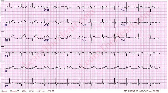 Inferior Cardiac : 下心脏