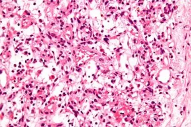 Inflammatory Myofibroblastic Tumour : 炎性肌纤维母细胞肿瘤