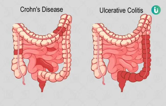 Inflammatory Pseudotumour : 炎性假瘤