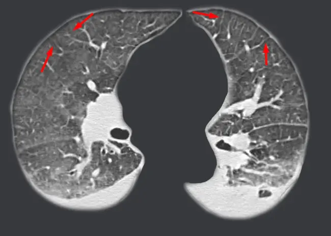 interlobular artery : 小叶间动脉