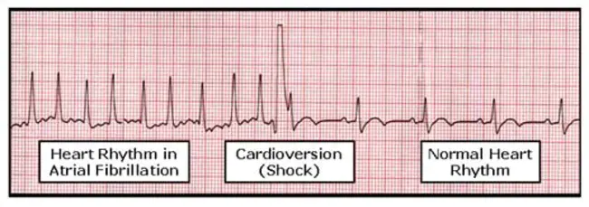 Internal Cardioversion : 心内复律