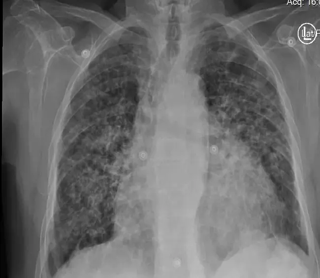 Interstitial Brachytherapy : 间质近距离放射治疗