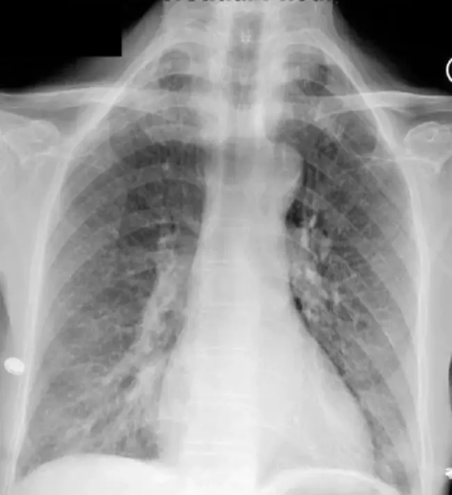 Interstitial Pneumonia : 间质性肺炎