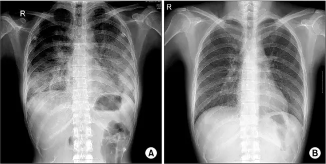Interstitial Radiation Pneumonitis : 间质性放射性肺炎