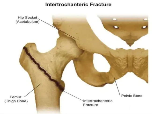 intertrochanteric : 粗隆间的