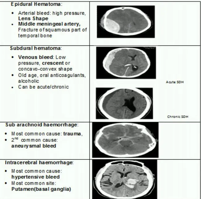 intracranial bleeding : 颅内出血