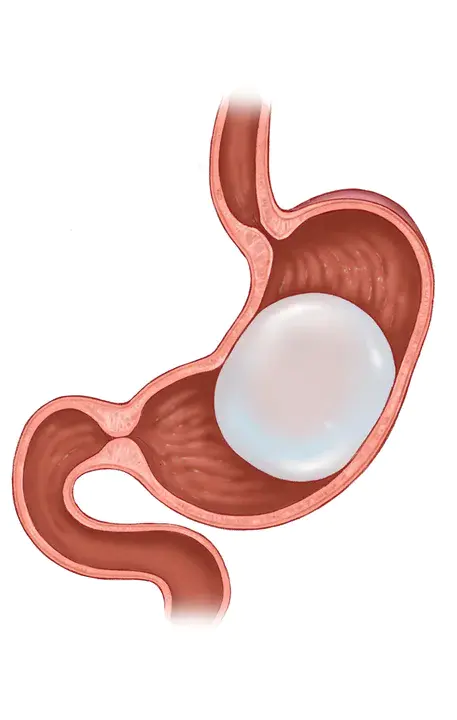 intragastric : 胃内的