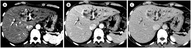 intrahepatic cholangiocarcinoma : 肝内胆管癌