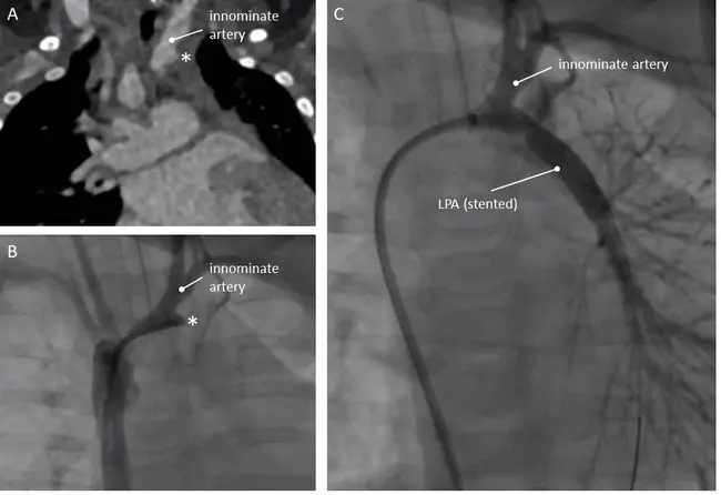 Intralobar Pulmonary Artery : 叶内肺动脉