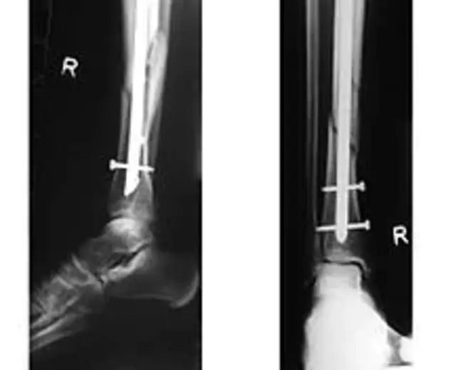 intramedullary rod : 髓内棒