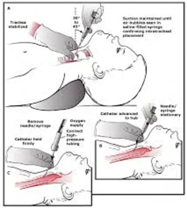 intratracheal pressure : 气管内压