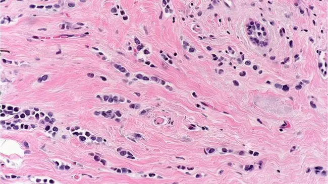 Invasive Carcinoma : 浸润性癌