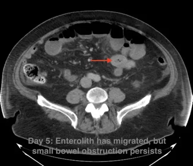 Jejunal Diverticulitis : 空肠憩室炎