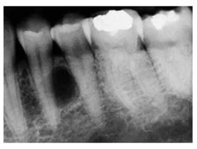 Lateral Periodontal Cyst : 牙周侧面囊肿