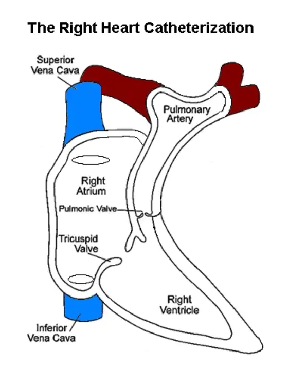 Left Heart Catheterization : 左心导管插入术