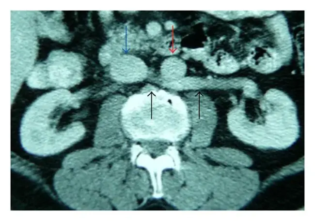 Left Renal Artery : 左肾动脉