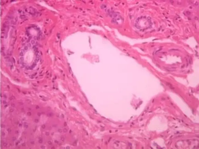 Liver Cell Adenoma : 肝细胞腺瘤