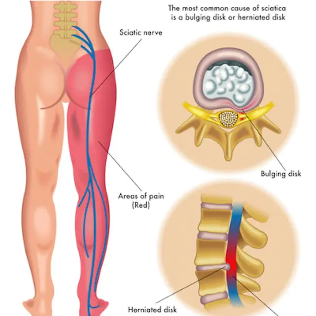 Lumbar Epidural Anaesthesia : 腰硬联合麻醉