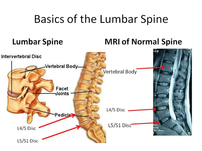 Lumbar Punctures : 腰椎穿刺