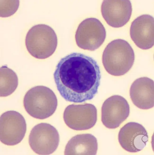 Lymphocyte Depletion : 淋巴细胞减少