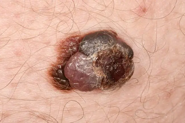 malignant haemangioendothelioma : 恶性血管内皮瘤