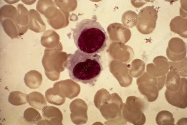 Malignant Histiocytosis : 恶性组织细胞病