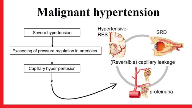 Malignant Hypertension : 恶性高血压