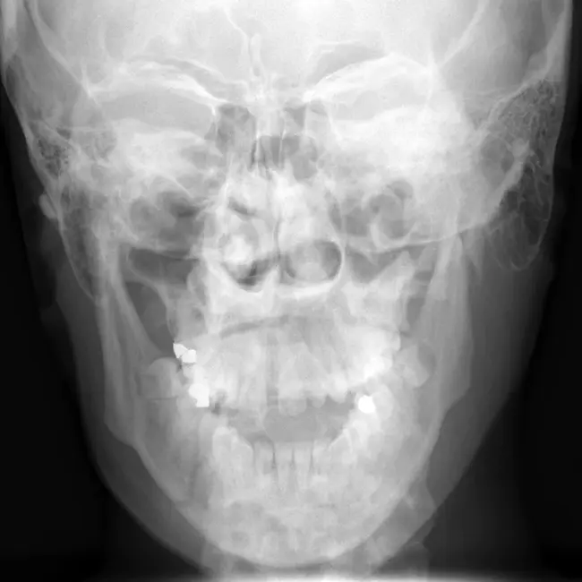 Mandibular Angle Plane : 下颌角平面