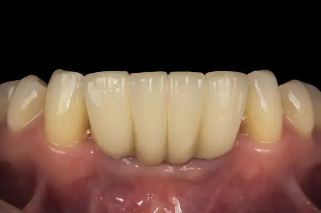 Mandibular Cortical Index : 下颌皮质指数