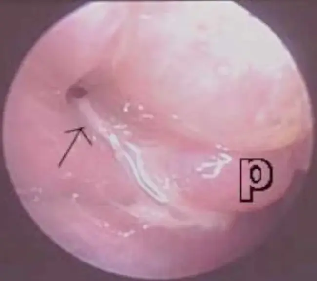 Maxillary Process : 上颌突